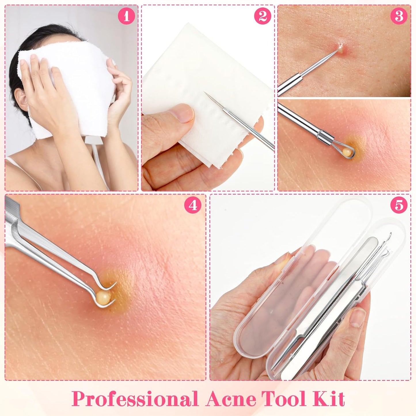 3Pcs Blackhead Tweezers, Stainless Steel Ingrown Hair Needle Kit with Box, Sebaceous Filament Tweezers, Milia Remover Milia Extraction Tools for Quick and Easy Removal of Pimples Blackheads Zit