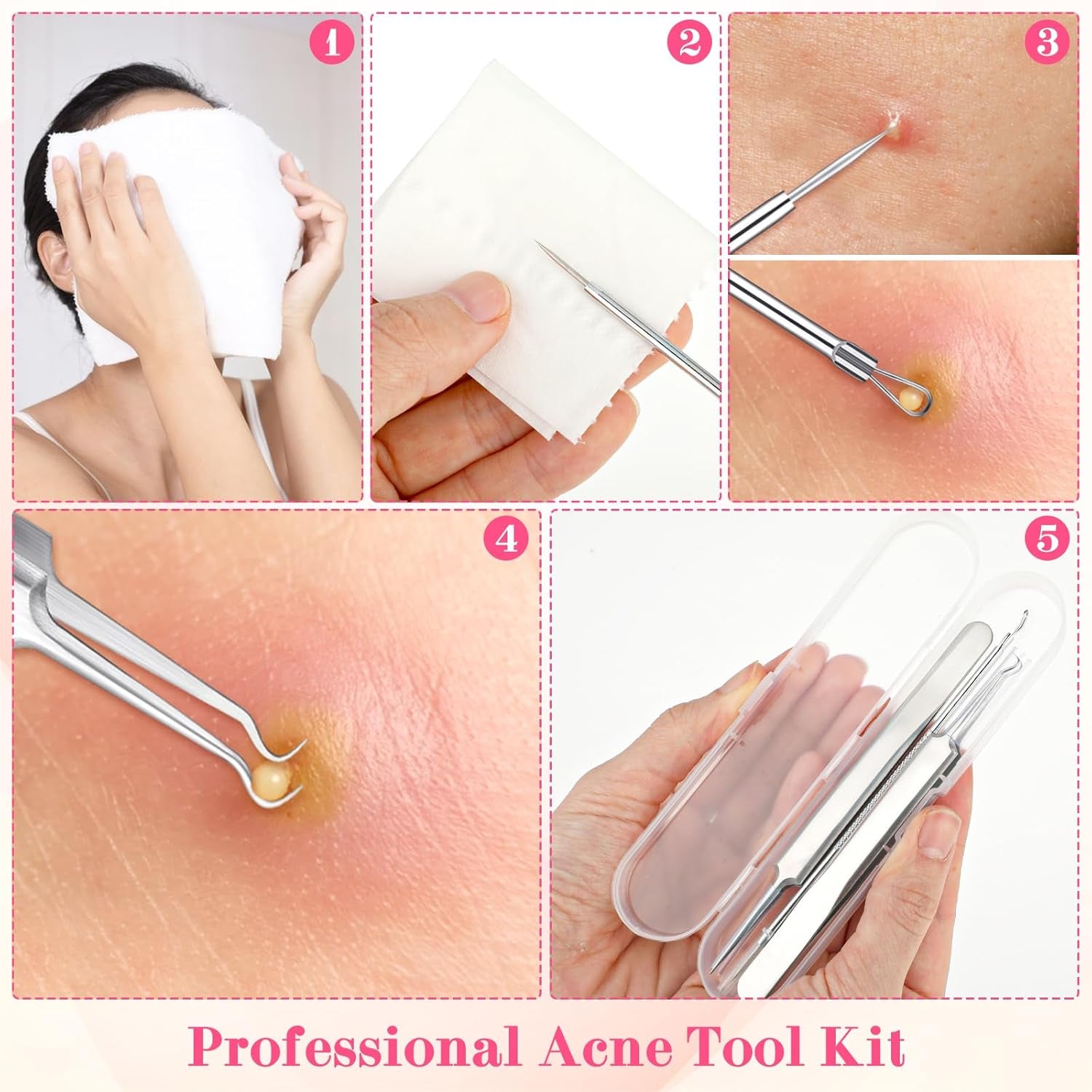 3Pcs Blackhead Tweezers, Stainless Steel Ingrown Hair Needle Kit with Box, Sebaceous Filament Tweezers, Milia Remover Milia Extraction Tools for Quick and Easy Removal of Pimples Blackheads Zit